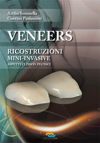 Veneers. Ricostruzioni minimamente invasive
