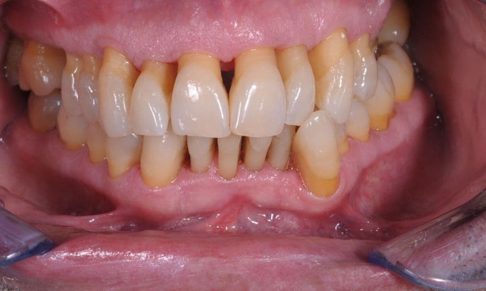 Parodontite come curare la malattia parodontale?