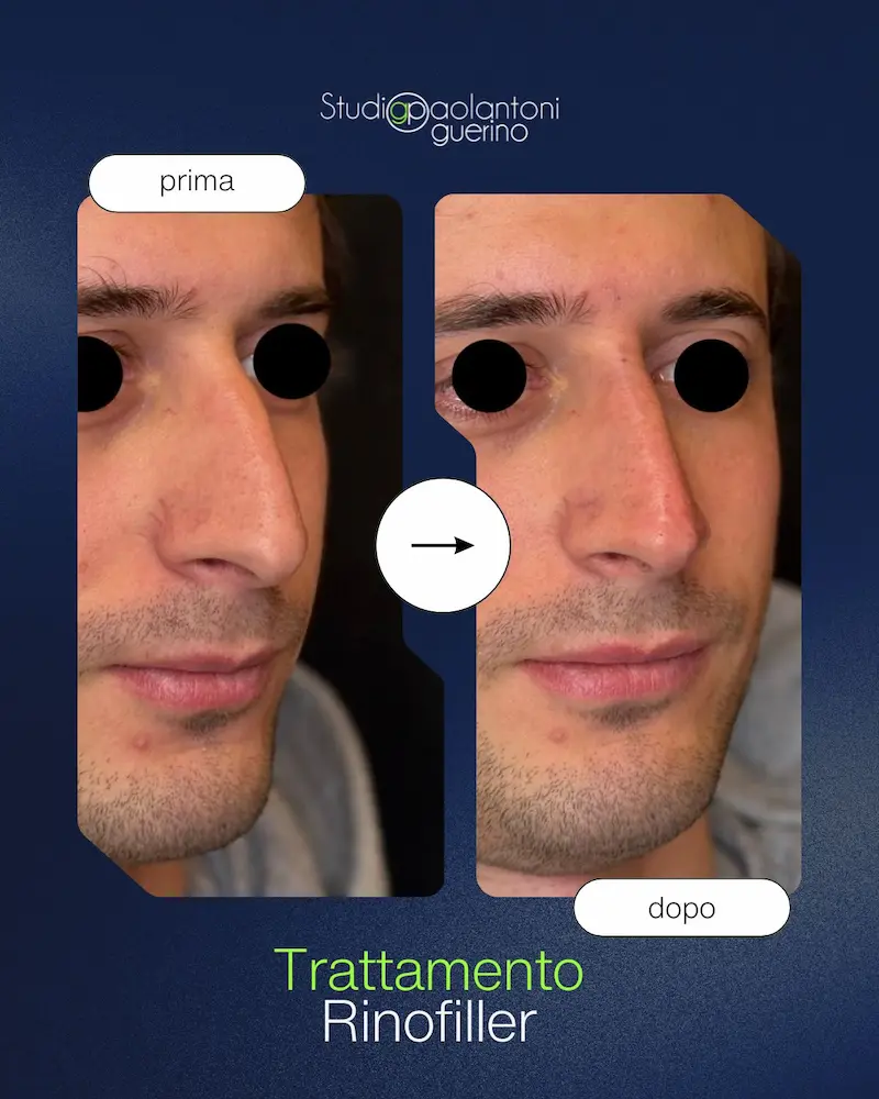 Trattamento Rinofiller - Prima e Dopo