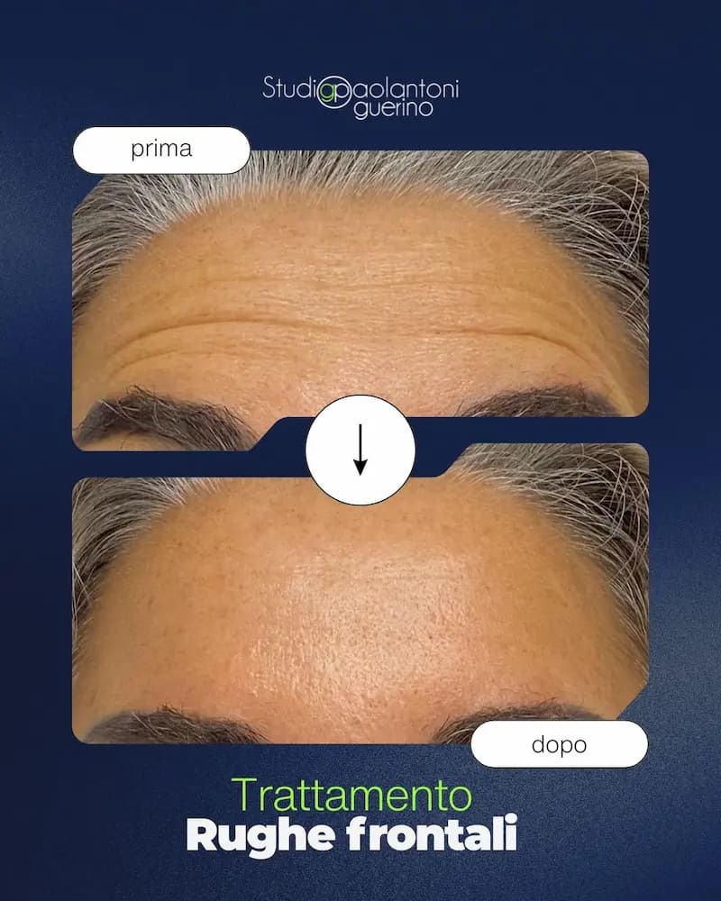 Trattamento Rughe Frontali - Prima e Dopo