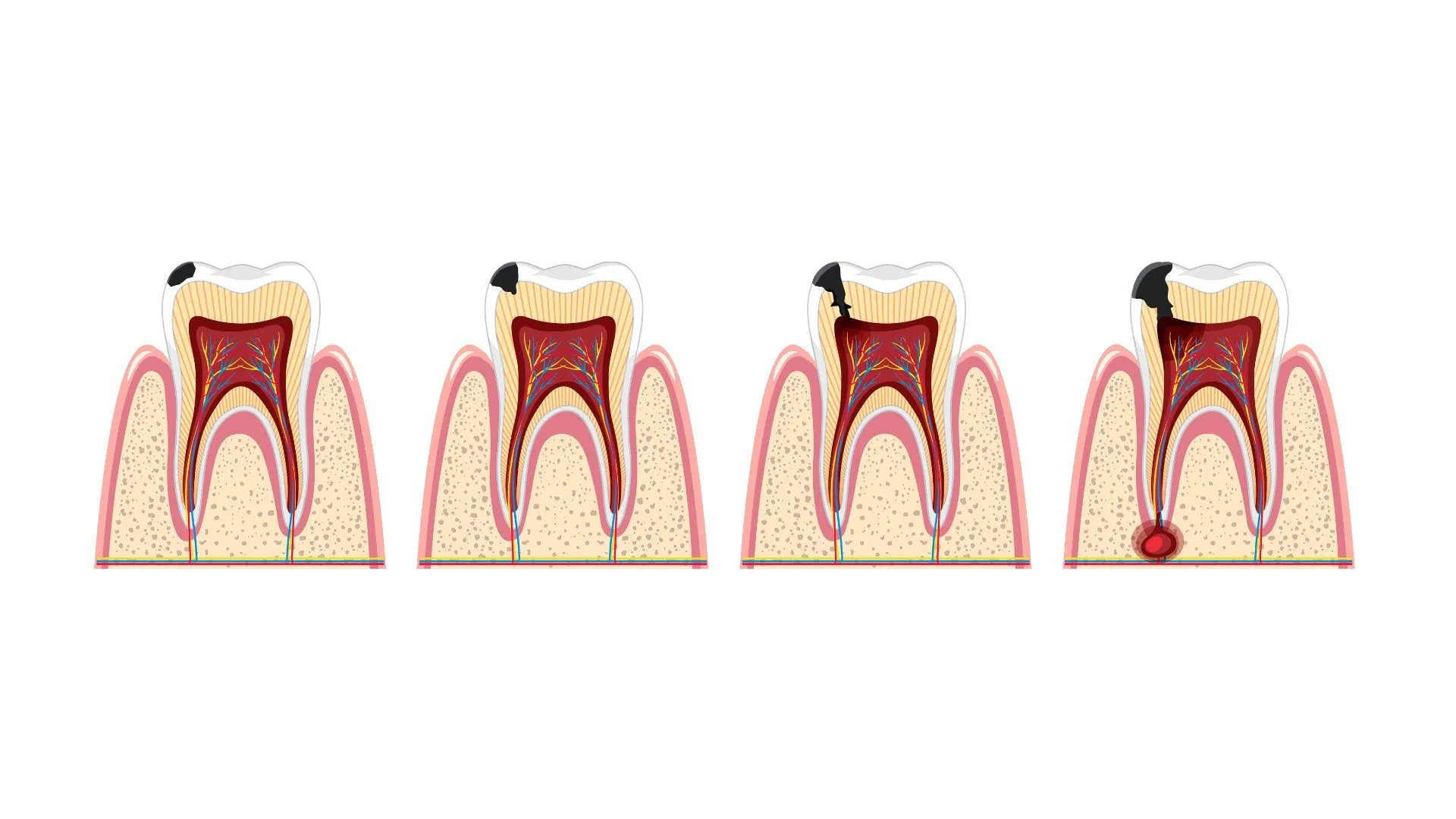 La Parodontite colpisce il 50% della popolazione, conosciamola meglio