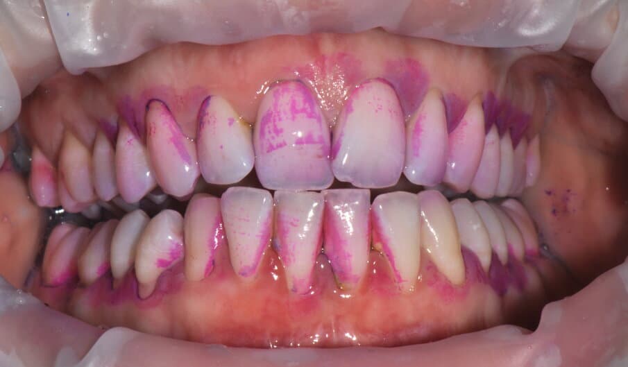 SOS GENGIVITE: IL PROTOCOLLO EFFICACE