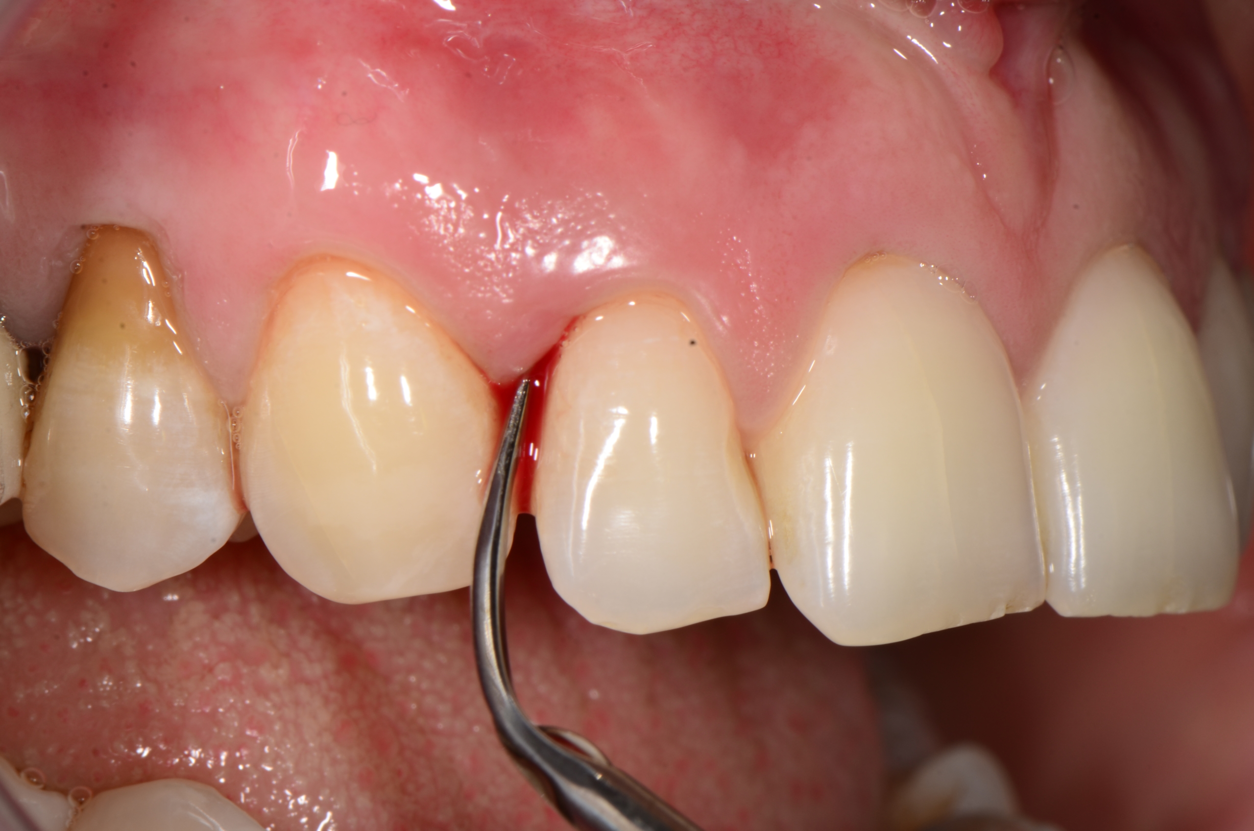 Fase di terapia parodontale non chirurgica